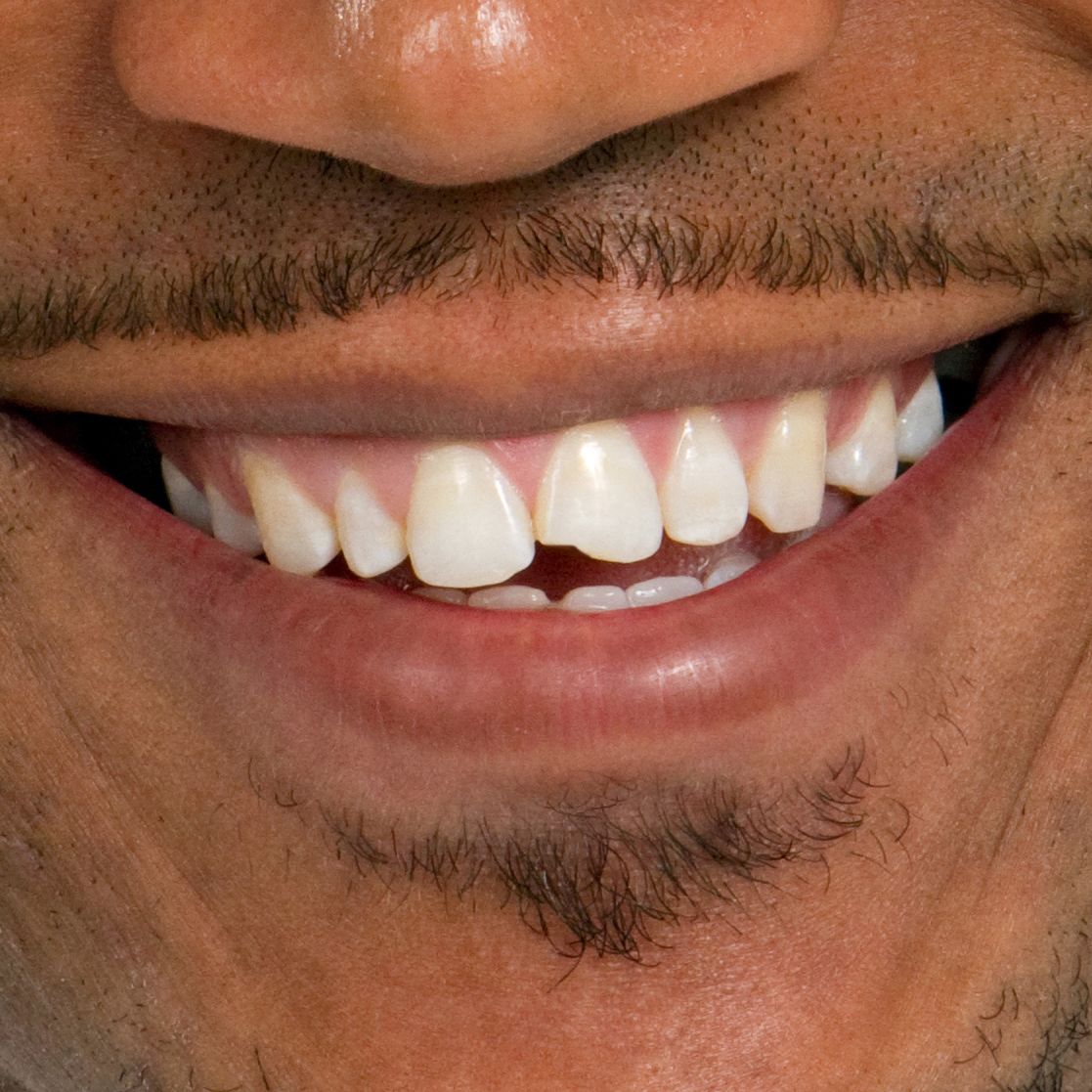 A chipped tooth