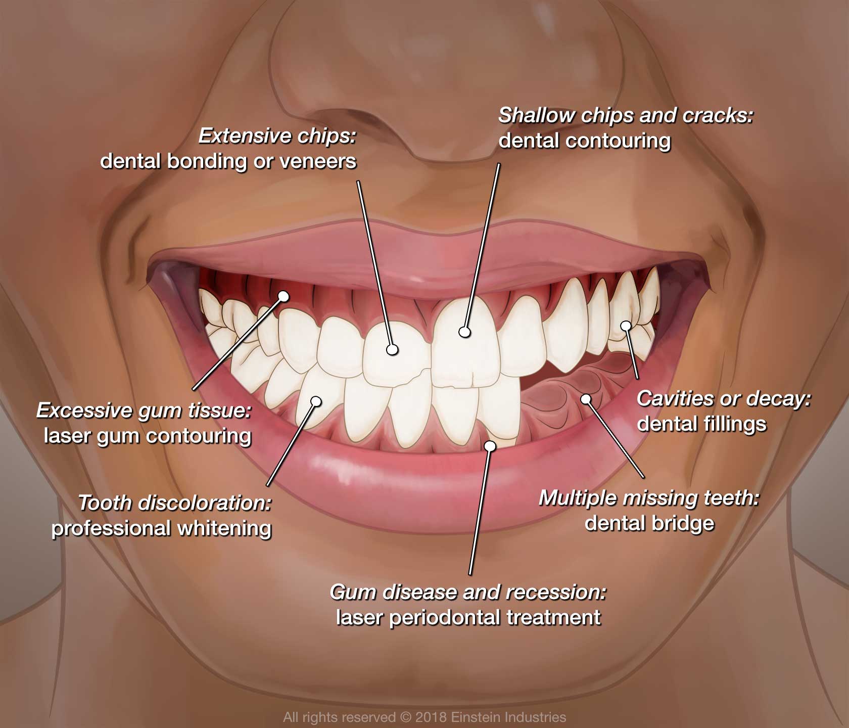 Cosmetic Dentistry treats extensive chips with dental bonding or veneers, shallow chips and cracks with dental contouring, cavities or decay with dental fillings, multiple missing teeth with a dental bridge, gum disease and recession with laser periodontal treatment, tooth discoloration with professional whitening, and excessive gum tissue with laser gum contouring.