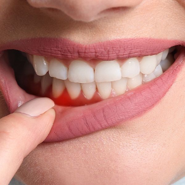 Patient pulling down lower lip to point at reddened gums
