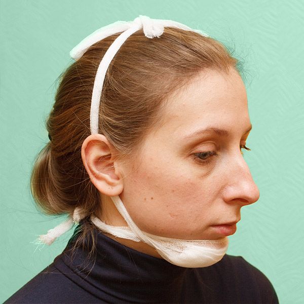 Woman with bandages wrapped to supported jaw