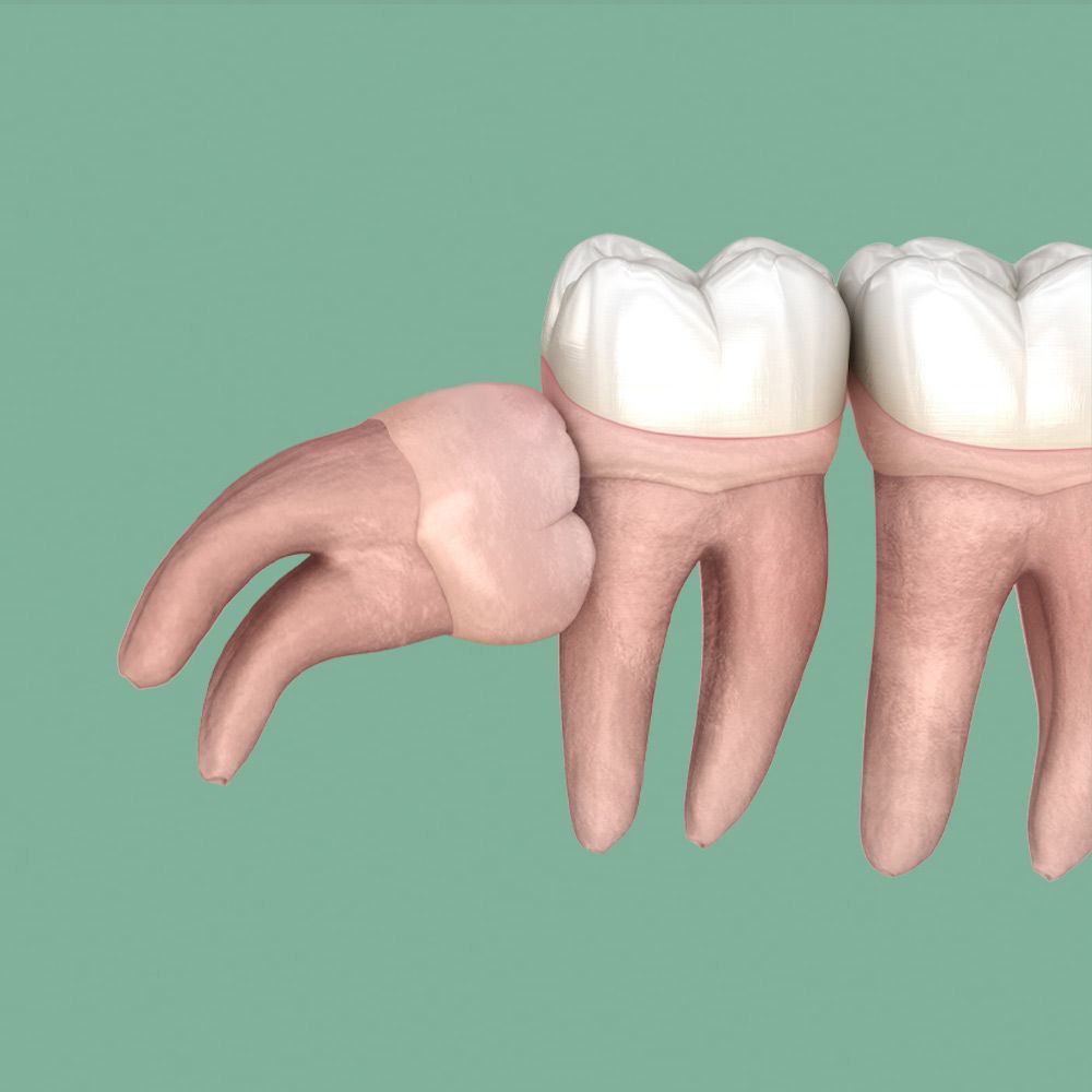 Impacted wisdom tooth